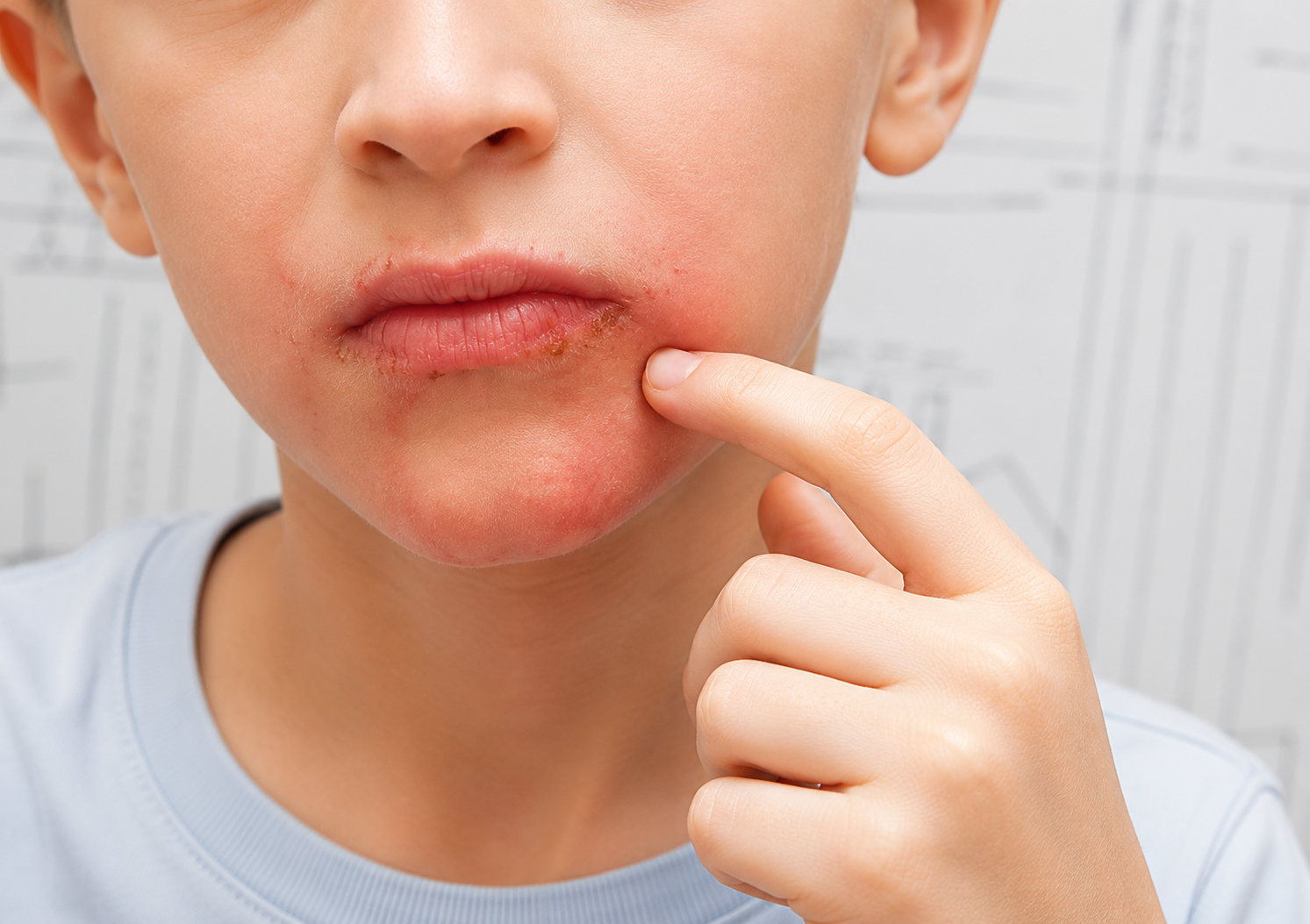 Impetigo support