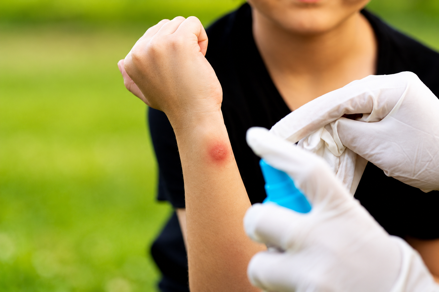 Infected insect bites support